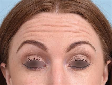 Botox before at La Jolla Facial Plastic Surgery: Victor Chung, MD in San Diego, CA