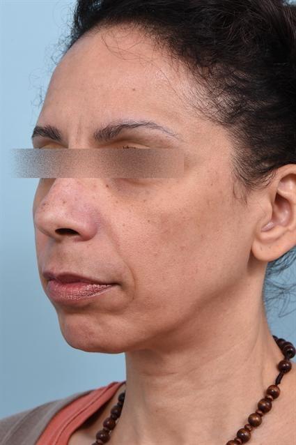 Dermal Fillers before at La Jolla Facial Plastic Surgery: Victor Chung, MD in San Diego, CA