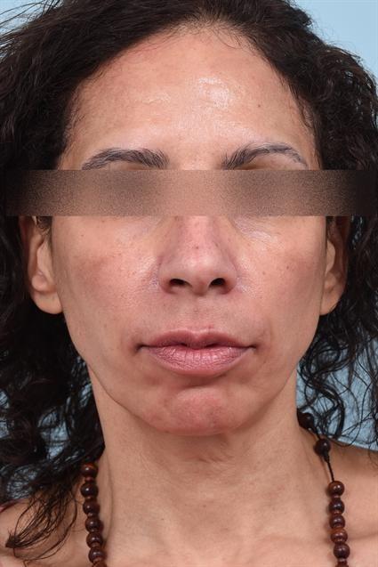 Dermal Fillers after at La Jolla Facial Plastic Surgery: Victor Chung, MD in San Diego, CA