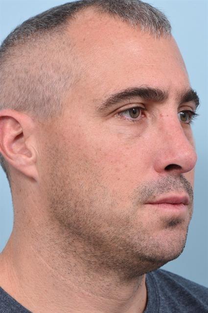 La Jolla Facial Plastic Surgery: Victor Chung, MD rhinoplasty after — San Diego, CA