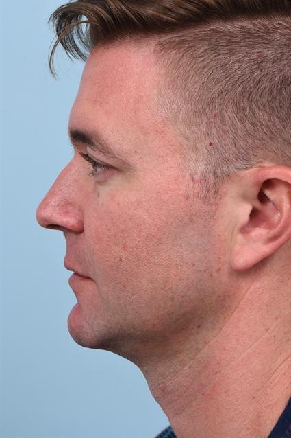 Dermal Fillers after at La Jolla Facial Plastic Surgery: Victor Chung, MD in San Diego, CA