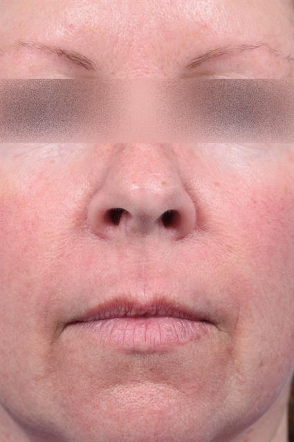 Laser Skin Resurfacing after at La Jolla Facial Plastic Surgery: Victor Chung, MD in San Diego, CA