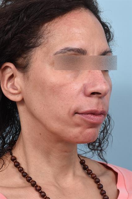 Dermal Fillers after at La Jolla Facial Plastic Surgery: Victor Chung, MD in San Diego, CA