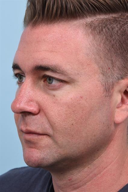 Dermal Fillers before at La Jolla Facial Plastic Surgery: Victor Chung, MD in San Diego, CA