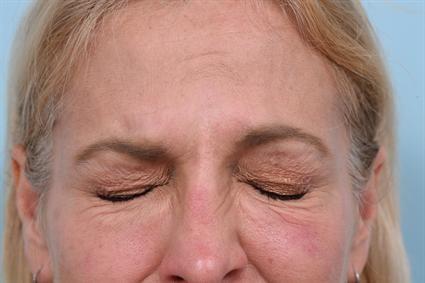 Botox after at La Jolla Facial Plastic Surgery: Victor Chung, MD in San Diego, CA