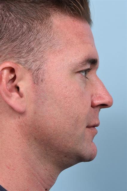 Dermal Fillers before at La Jolla Facial Plastic Surgery: Victor Chung, MD in San Diego, CA