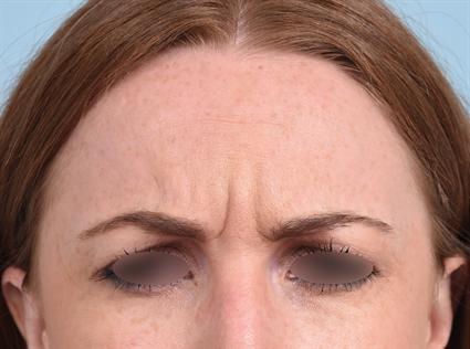 Botox before at La Jolla Facial Plastic Surgery: Victor Chung, MD in San Diego, CA