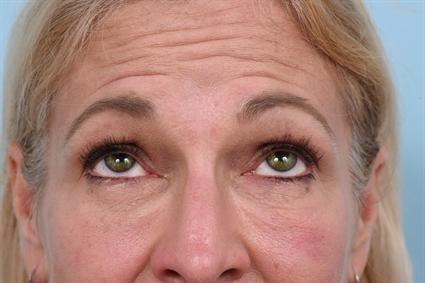 Botox after at La Jolla Facial Plastic Surgery: Victor Chung, MD in San Diego, CA