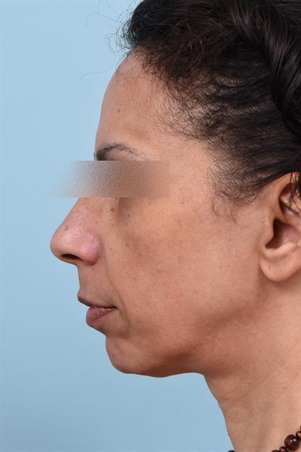 Dermal Fillers before at La Jolla Facial Plastic Surgery: Victor Chung, MD in San Diego, CA