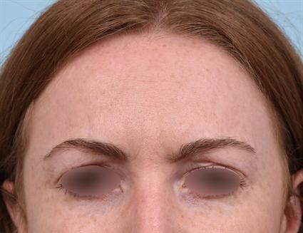 Botox after at La Jolla Facial Plastic Surgery: Victor Chung, MD in San Diego, CA