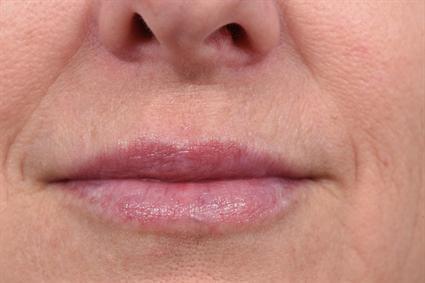 Lip Filler after at La Jolla Facial Plastic Surgery: Victor Chung, MD in San Diego, CA