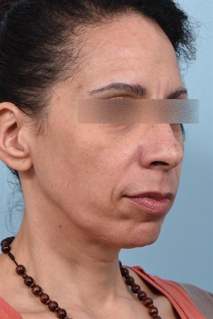 Dermal Fillers before at La Jolla Facial Plastic Surgery: Victor Chung, MD in San Diego, CA