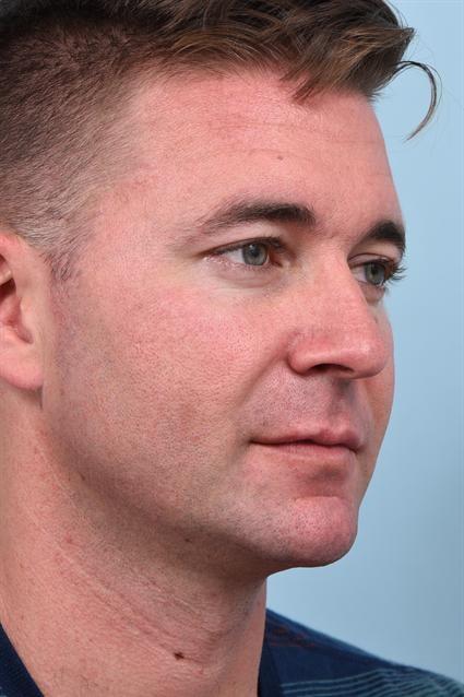 Dermal Fillers after at La Jolla Facial Plastic Surgery: Victor Chung, MD in San Diego, CA