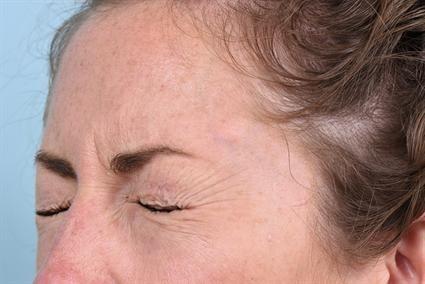 Botox before at La Jolla Facial Plastic Surgery: Victor Chung, MD in San Diego, CA