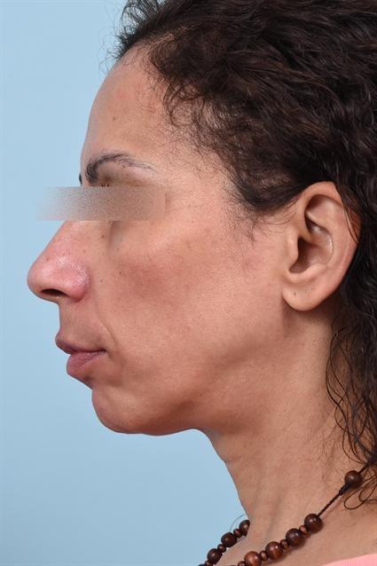 Dermal Fillers after at La Jolla Facial Plastic Surgery: Victor Chung, MD in San Diego, CA
