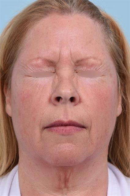 Botox before at La Jolla Facial Plastic Surgery: Victor Chung, MD in San Diego, CA