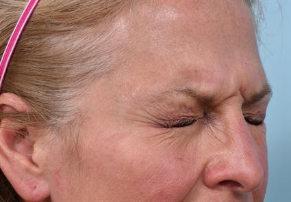 Botox before at La Jolla Facial Plastic Surgery: Victor Chung, MD in San Diego, CA