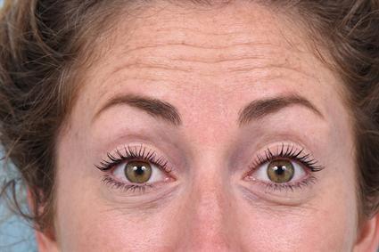 Botox before at La Jolla Facial Plastic Surgery: Victor Chung, MD in San Diego, CA