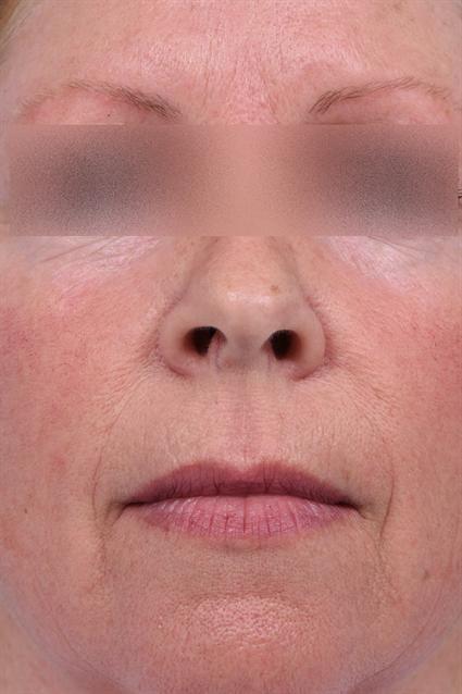 Laser Skin Resurfacing before at La Jolla Facial Plastic Surgery: Victor Chung, MD in San Diego, CA