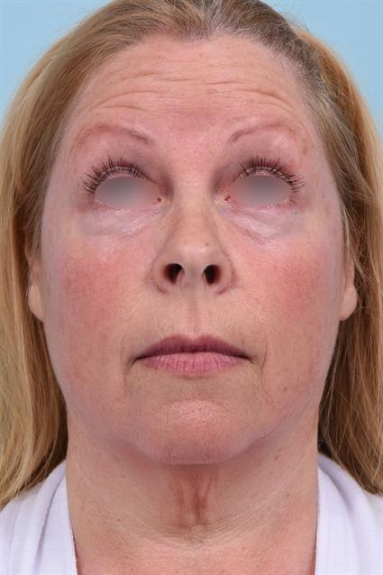 Botox before at La Jolla Facial Plastic Surgery: Victor Chung, MD in San Diego, CA