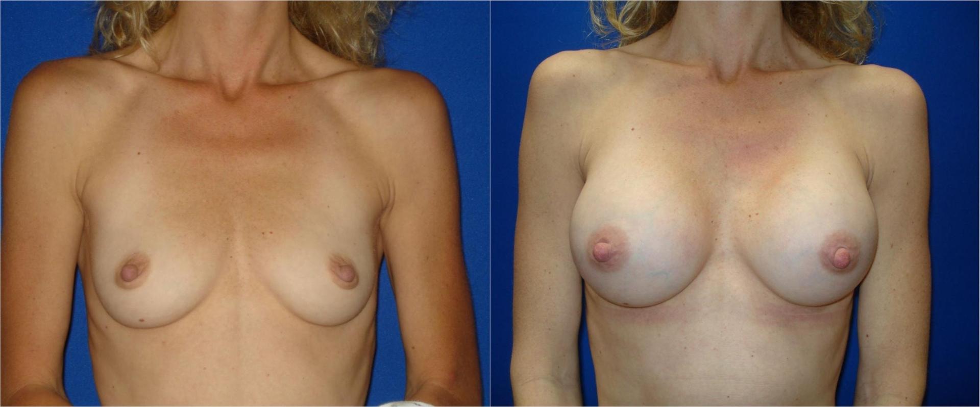 Persons Plastic Surgery (Barbara L. Persons, MD) breast augmentation result — Lafayette, CA