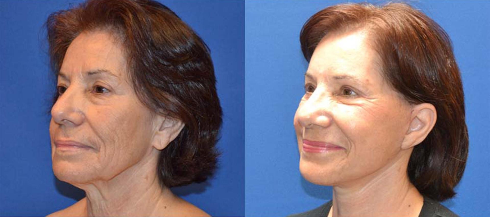 Persons Plastic Surgery (Barbara L. Persons, MD) facelift result — Lafayette, CA