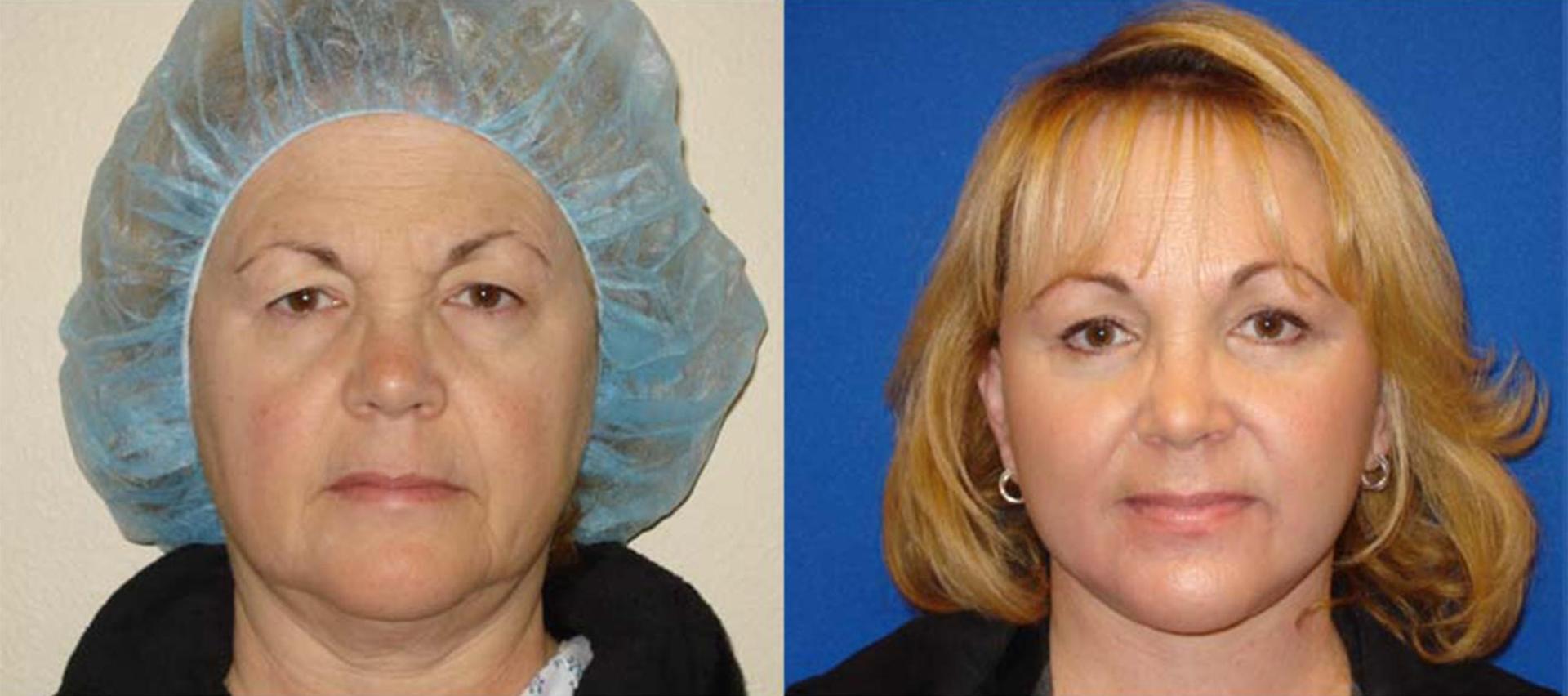 Persons Plastic Surgery (Barbara L. Persons, MD) facelift result — Lafayette, CA
