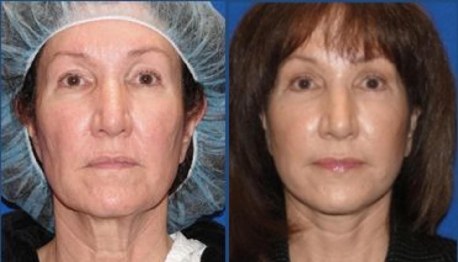 Persons Plastic Surgery (Barbara L. Persons, MD) facelift result — Lafayette, CA