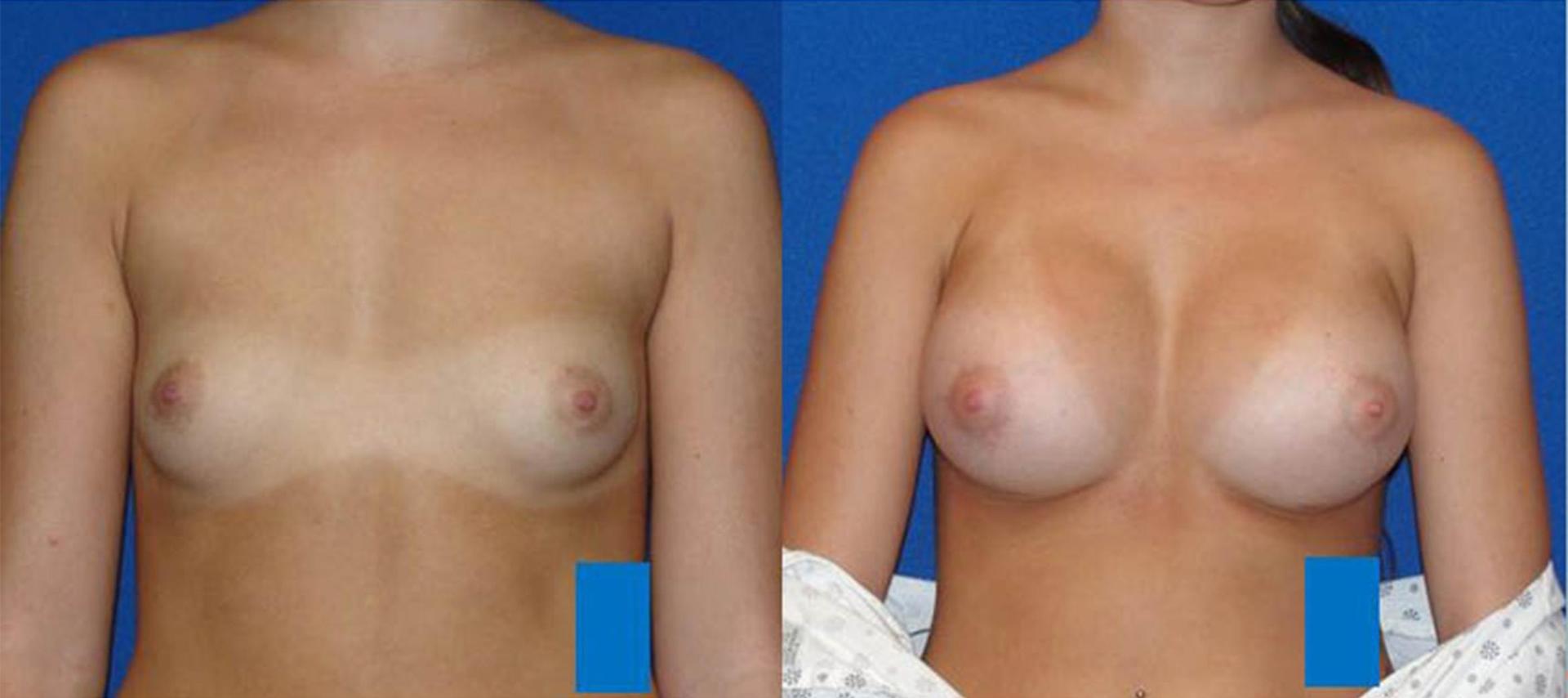 Persons Plastic Surgery (Barbara L. Persons, MD) breast augmentation result — Lafayette, CA