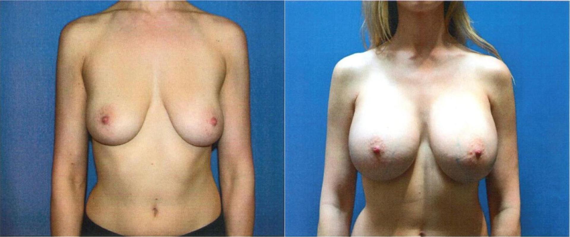 Persons Plastic Surgery (Barbara L. Persons, MD) breast augmentation result — Lafayette, CA
