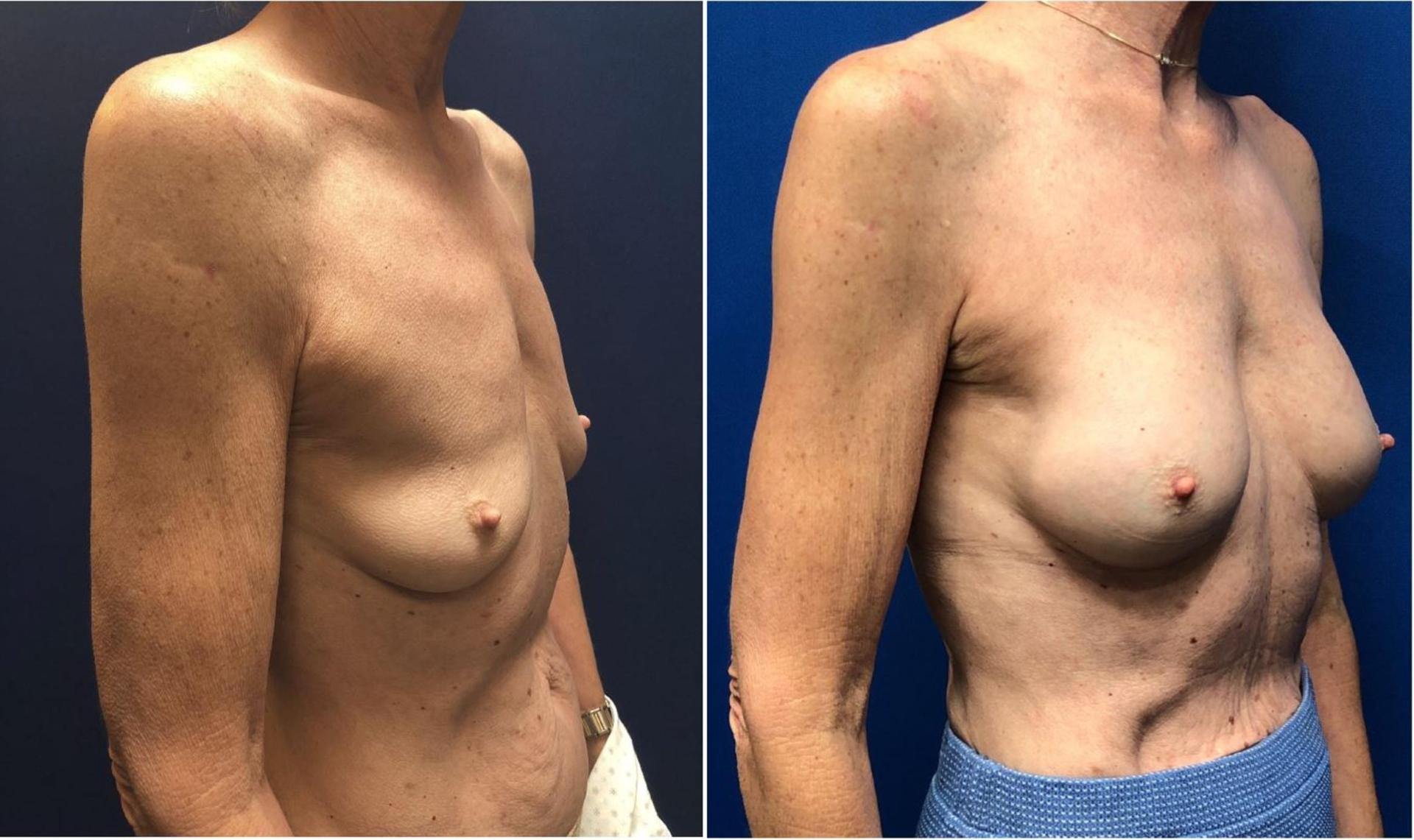 Persons Plastic Surgery (Barbara L. Persons, MD) breast augmentation result — Lafayette, CA