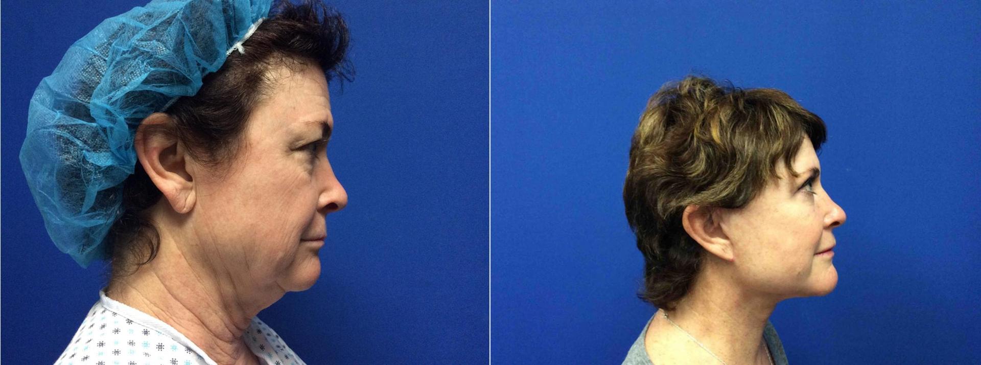 Persons Plastic Surgery (Barbara L. Persons, MD) facelift result — Lafayette, CA