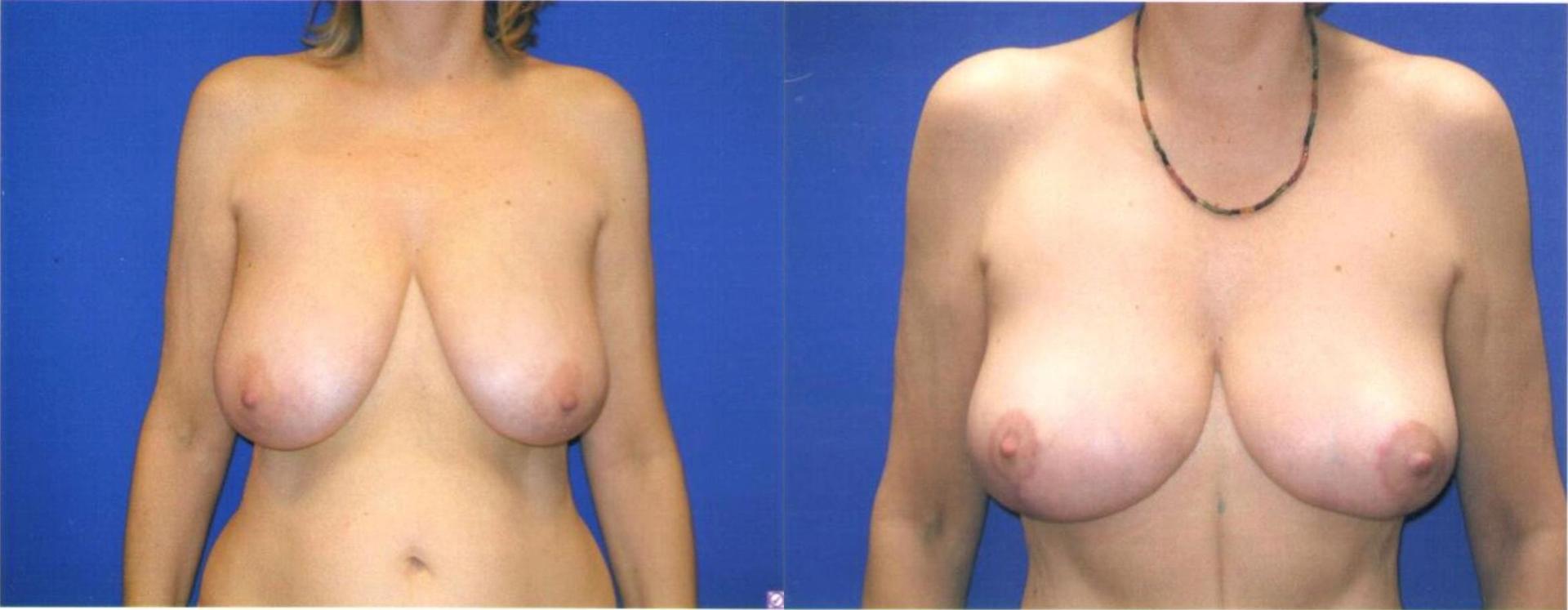 Persons Plastic Surgery (Barbara L. Persons, MD) breast lift result — Lafayette, CA