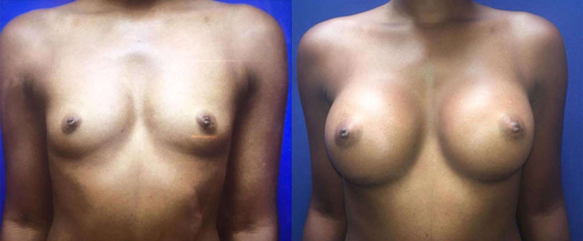 Persons Plastic Surgery (Barbara L. Persons, MD) breast augmentation result — Lafayette, CA