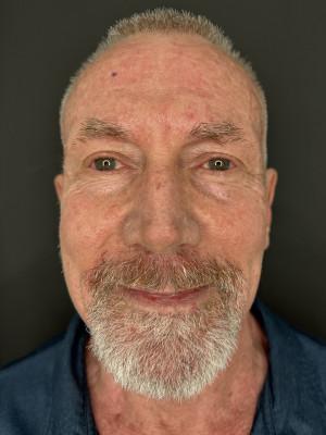 Laser Skin Resurfacing before at Cosmetic Surgery Dallas in Dallas, TX
