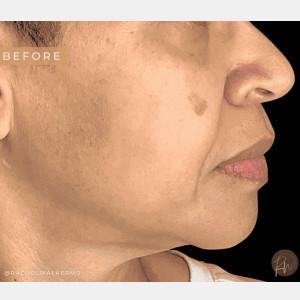 Chemical Peel before at Cosmetic Surgery Dallas in Dallas, TX