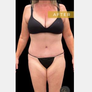 Cosmetic Surgery Dallas tummy tuck after — Dallas, TX