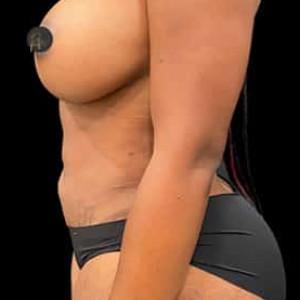 Cosmetic Surgery Dallas tummy tuck after — Dallas, TX