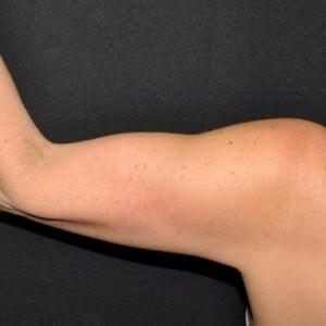Arm Lift after at Cosmetic Surgery Dallas in Dallas, TX