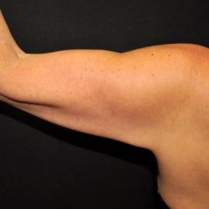 Arm Lift before at Cosmetic Surgery Dallas in Dallas, TX