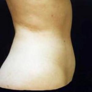Liposuction after at Cosmetic Surgery Dallas in Dallas, TX