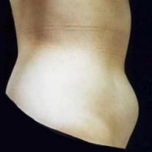 Liposuction before at Cosmetic Surgery Dallas in Dallas, TX