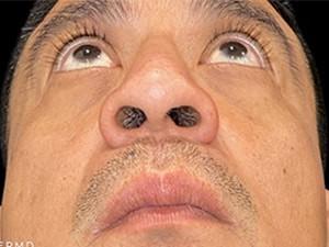 Liquid Rhinoplasty after at Cosmetic Surgery Dallas in Dallas, TX