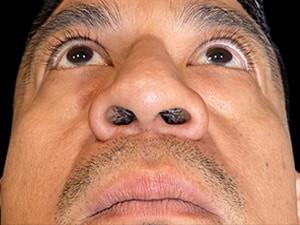 Liquid Rhinoplasty before at Cosmetic Surgery Dallas in Dallas, TX
