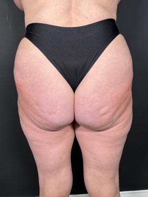 Cosmetic Surgery Dallas bbl after — Dallas, TX