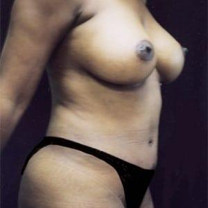 Cosmetic Surgery Dallas body contouring after — Dallas, TX