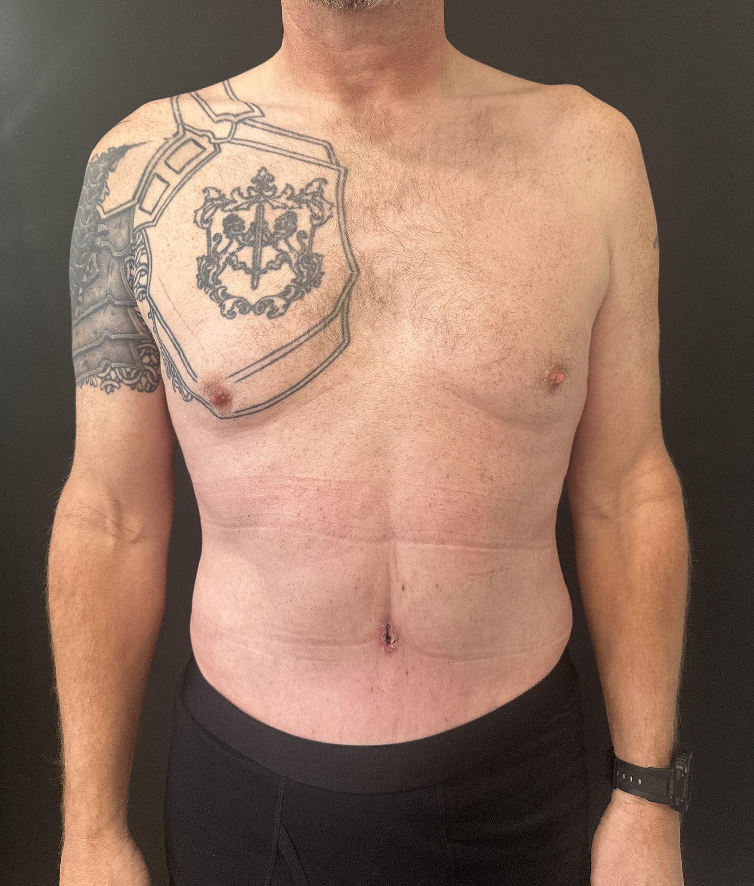 Cosmetic Surgery Dallas tummy tuck after — Dallas, TX