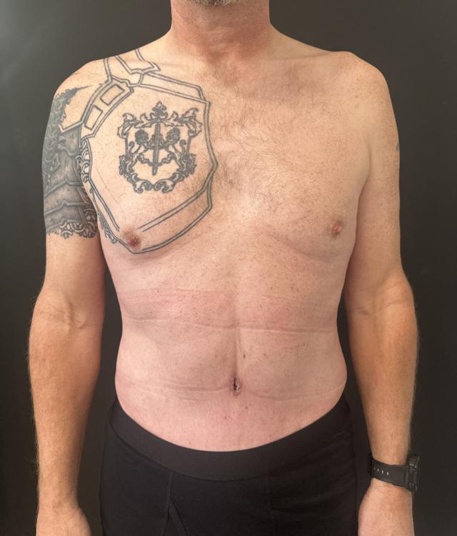 Tummy Tuck after at Cosmetic Surgery Dallas in Dallas, TX