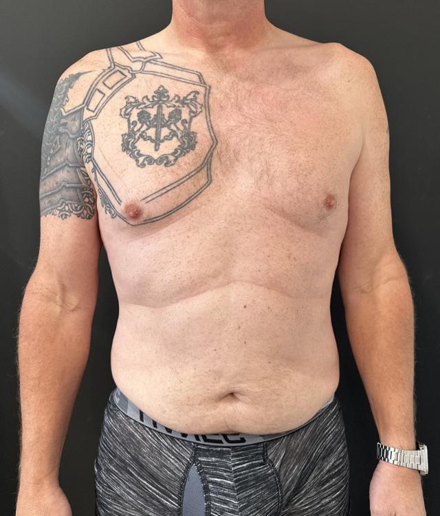 Tummy Tuck before at Cosmetic Surgery Dallas in Dallas, TX