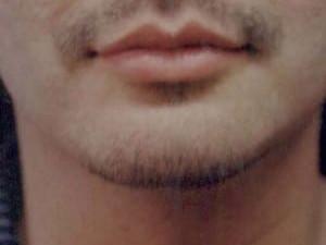 Chin Implant after at Cosmetic Surgery Dallas in Dallas, TX